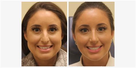 buccal fat removal nj